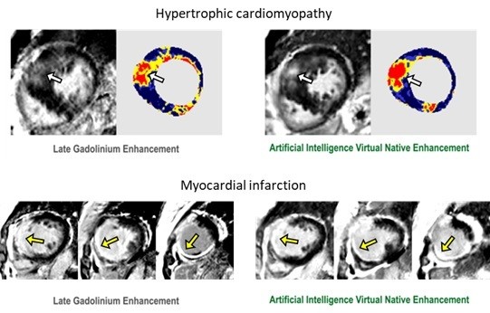 人工智能VNE在两种不同心脏病心肌瘢痕检测中的应用。
